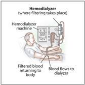 hemodialyzer